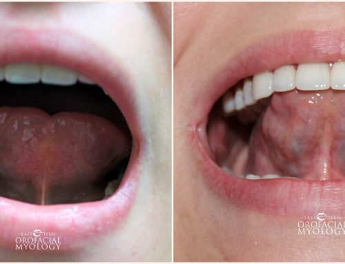 Before & After Adult Frenectomy